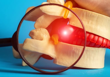 Magnified view of spinal disc herniation with pressure on nerve root.