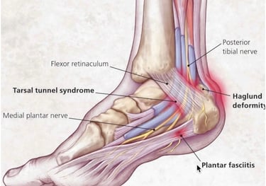 Anatomic diagram of foot showing plantar fasciitis pain in the heel.