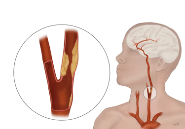 Carotid artery stenosis- Dr. Omar Hamdallah