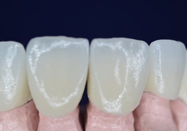 Coronas en porcela y zirconia en Jarabacoa, La Vega, Republica Dominicana