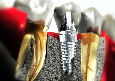 Implantes dentales Jarabacoa, La Vega, Republica Dominicana