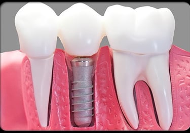 Implante dental