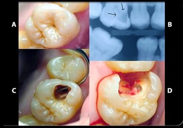 Caries diente