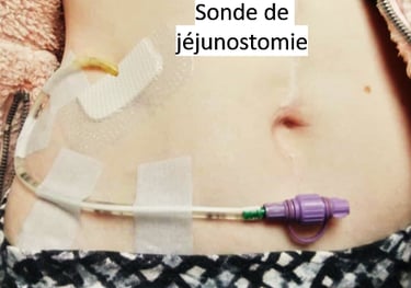 jéjunostomie