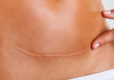 osteopatia per il trattamento delle cicatrici