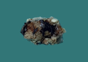 anatomía patológica neuropatología