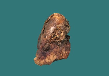 anatomía patológica tórax y mediastino