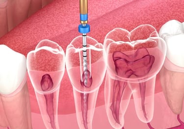 Tratamento de canal na facis odontologia taguatinga