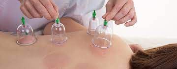 Professional cupping therapy