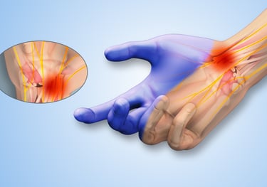 Anatomic image of inflamed wrist and carpal tunnel showing carpal tunnel syndrome nerve pain. 
