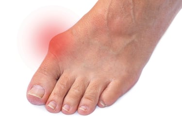 Close-up of a bunion with redness indicating an inflamed big toe joint. 