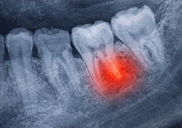 Tooth extraction Greenville SC