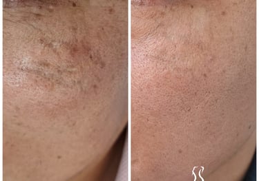 tratamiento cicatriz laser co2 fraccionado
