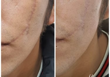 tratamiento cicatriz laser co2 fraccionado