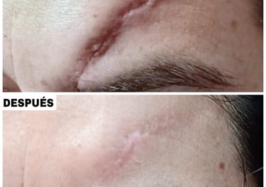 tratamiento cicatriz laser co2 fraccionado