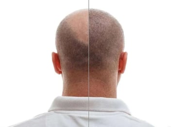 A before-and-after image of a patient showing successful hair transplantation results.