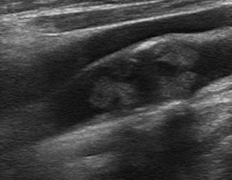 Carotid Duplex plaque