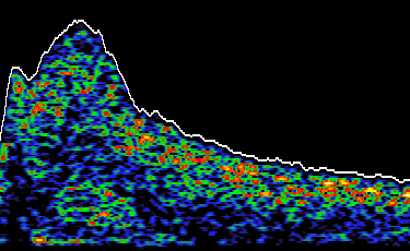 Transcranial Doppler TCD waveform