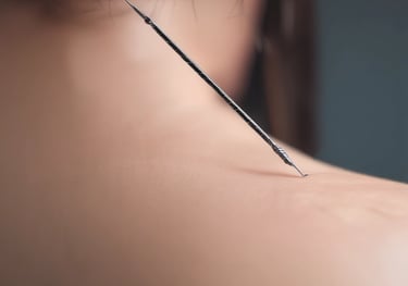 acupuncture