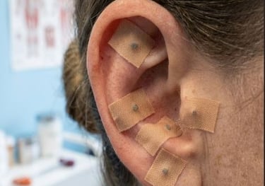 A close-up of a patient's ear with auricular acupuncture seeds applied using adhesive tape for holistic therapy.