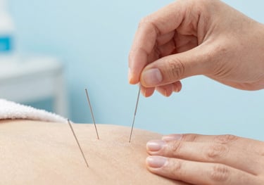 A practitioner performs an acupuncture treatment by inserting thin needles into a patient's back for pain relief.