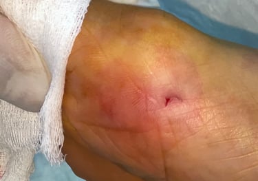 cirugia mini incision juantes, dedos en garra, espolón calcando, dolor del pie