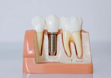 implantes de tipo carga inmediata en sevilla