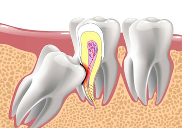 wisdom tooth removal by top oral surgeon in Evershine nagar Malad west in Mumbai