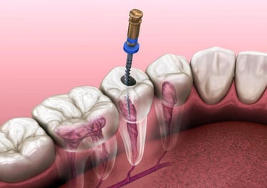 Endodoncia