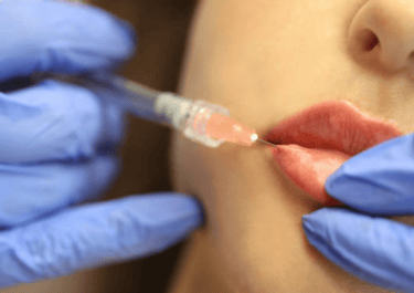 Remodelagem labial