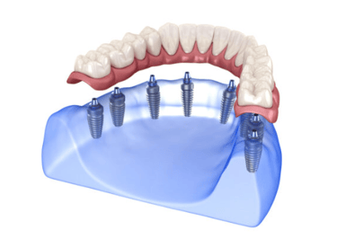 Dentita a Tirana Specializzati in riabilitazioni parziali, totali ed estreme