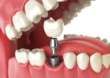 Dental Implant Treatment in Indore