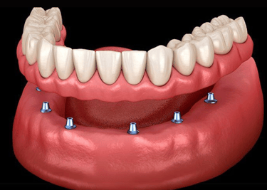 implante dentário