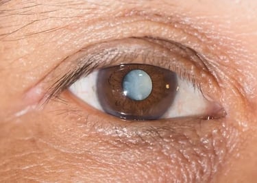 Close de um olho com catarata avançada, evidenciando a opacificação do cristalino