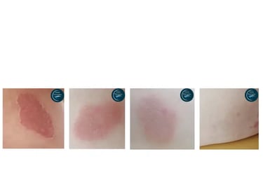 Eczéma