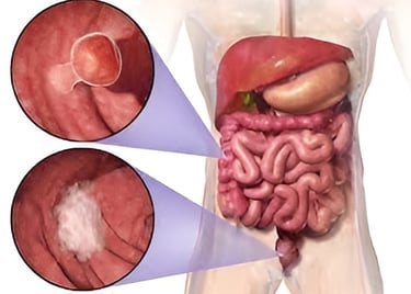 Imagen de Cáncer de Colon utilizado en la pagina web de la Dra. Arlenis Guzmán 