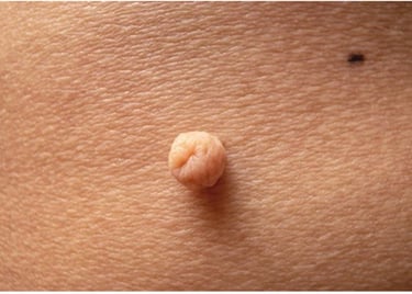 Pengangkatan Skin Tag Klinik Sehat Plus BSD