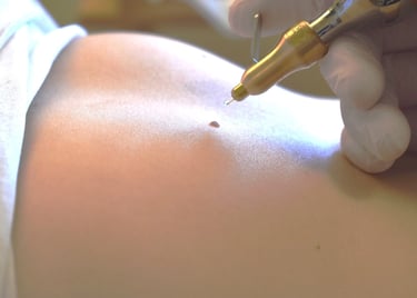 Dermatologist performing professional laser mole removal procedure on a patient's skin.