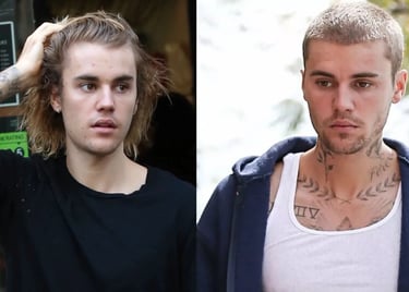 justin bieber hair transplant