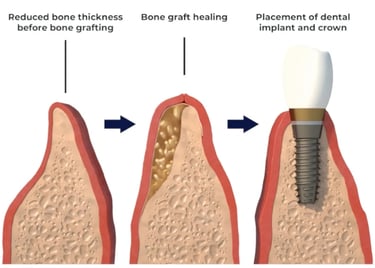 bone graft