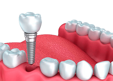 implante dentário