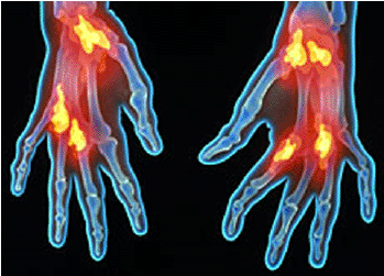 Tratamiento dolor Artritis Reumatoide