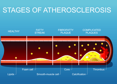 vascular ultrasound artery atherosclerosis stenosis disease stent bypass graft leg pain walking claudication peripheral block