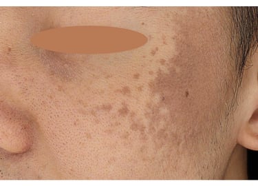 nevus of ota laser pigmentation removal