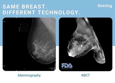 Mammography and KBCT image comparison showing different breast imaging technology