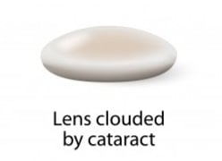 Image of a cloudy lens clouded with cataract.