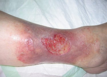 venous leg ulcer