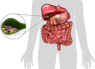 imagem ilustrativa parede de calculos biliares