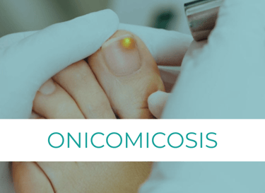 onicomicosis tratamiento laser