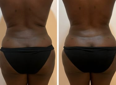 Mesoestetic Bodyshock results – body sculpting NYC